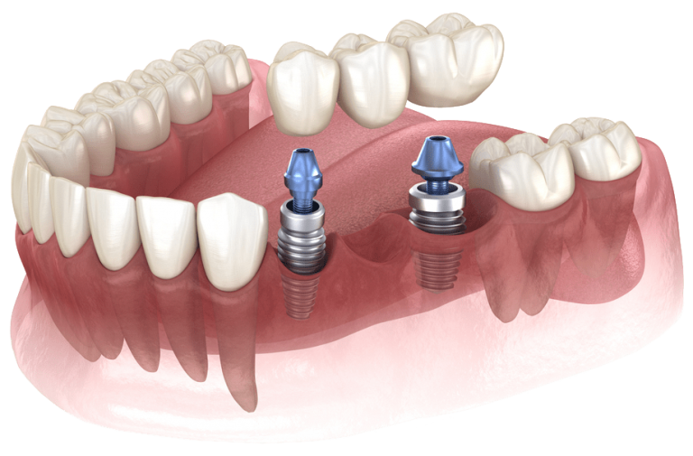 Dental Implants Oakville Restorative Dentistry Shore