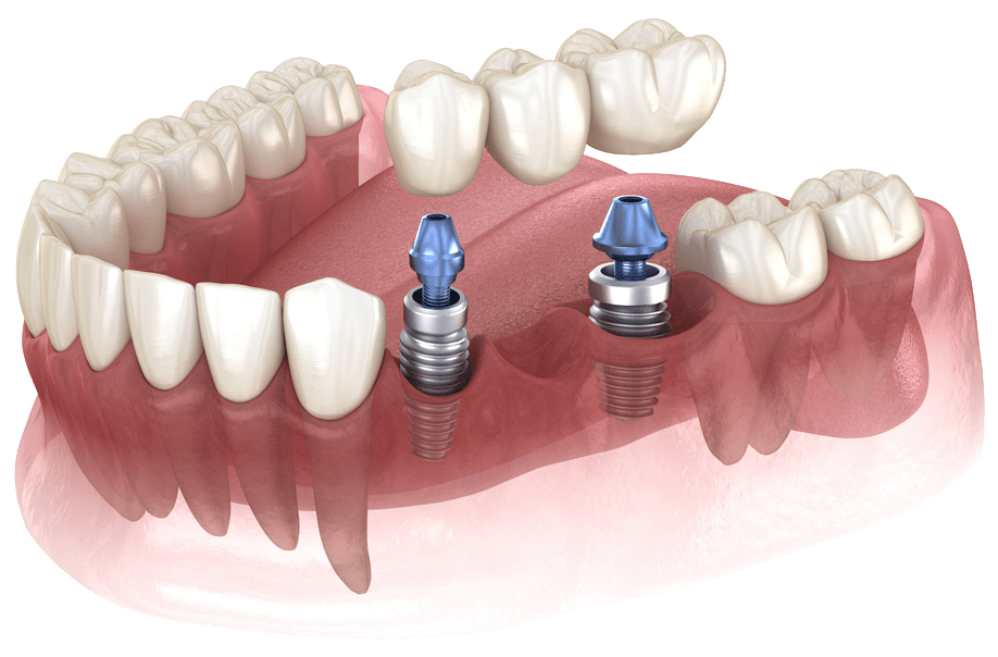 Dental implants placement | Tooth implant Oakville | Best dental implants in Oakville Ontario | Shore Side DentistryShore Side Dentistry
