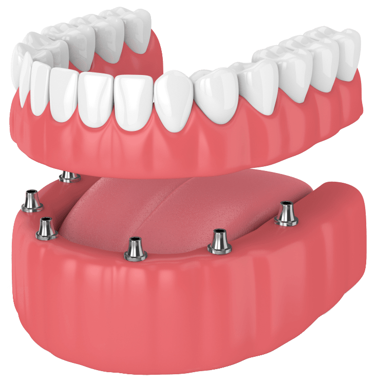 Tooth implant Oakville | Best dental implants in Oakville Ontario | Shore Side Dentistry