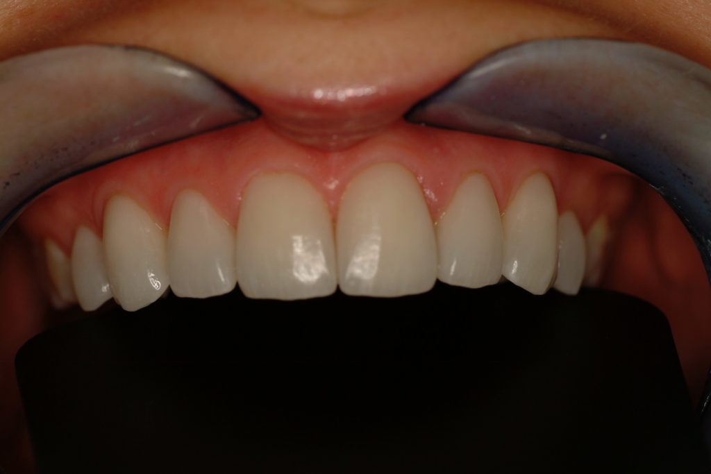 Porcelain Laminate Veneers upper Jaw | Shore Side Dentistry