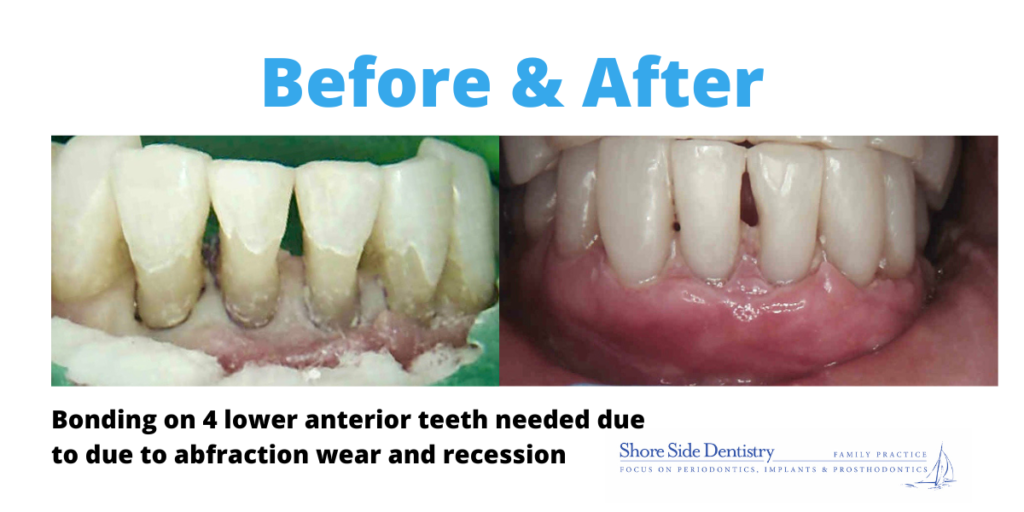 Before and after | Bonding on 4 lower anterior teeth | Shore Side Dentistry