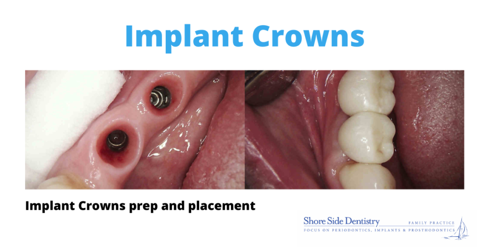 Implant Crowns prep and placement | Shore Side Dentistry