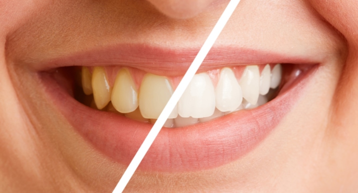 Before & After Teeth Whitening | Teeth Whitening Oakville | Shore Side Dentistry