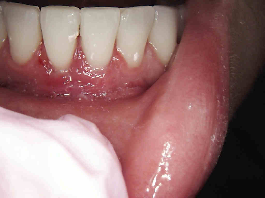 Gum Grafting- After- Shore Side Dentistry