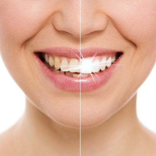What types of stains can affect your teeth| Shore Side Dentistry