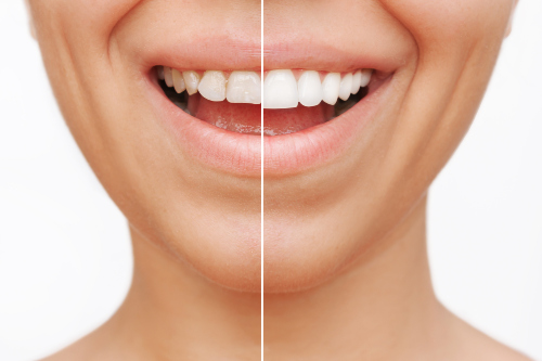 smile design | Shore Side dental Oakville