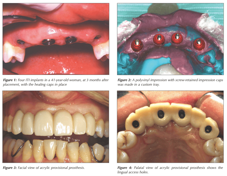 Fixed Implant Supported Prostheses | Dr. Peter Taylor | Shore Side dentistry