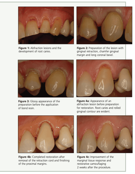 How to restore abfraction lesions in a predictable & aesthetic manner