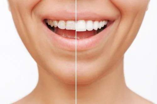 smile design | Shore Side dental Oakville
