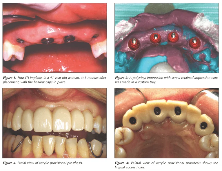 Fixed Implant Supported Prostheses | Dr. Peter Taylor | Shore Side dentistry