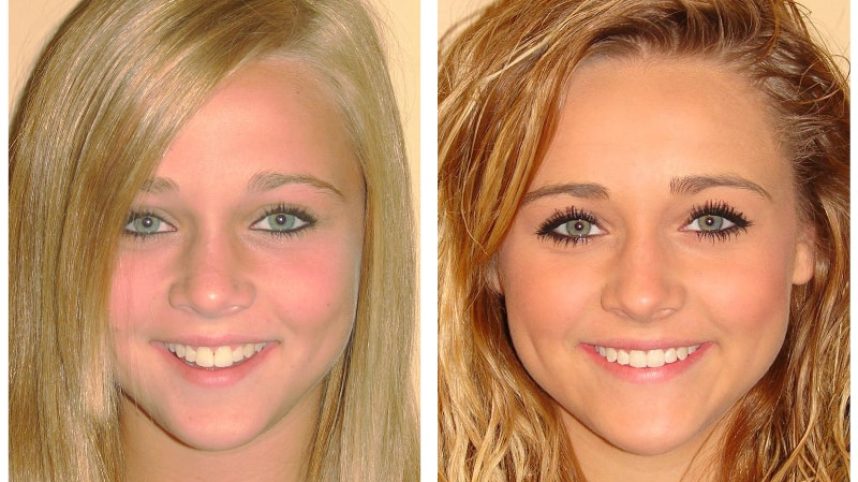 Teen girl Invisalign treatment | Before and After | Shore Side Dentistry